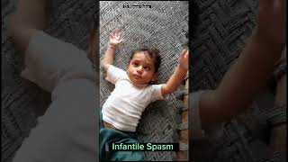 Infantile Spasm fits seizures infantilespasm epilepsy treatment [upl. by Tonie245]