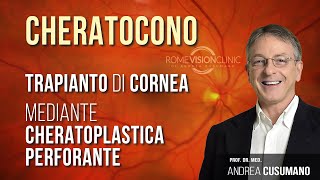 Cheratocono e trapianto di cornea cheratoplastica perforante [upl. by Ysle]