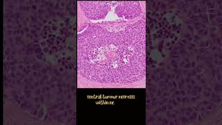 Medullary thyroid carcinoma [upl. by Bryna168]