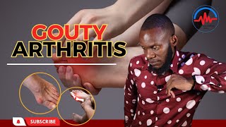 Gouty Arthritis Causes Symptoms and Treatment [upl. by Kamillah]