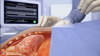 Epicardial Access System  cardiology [upl. by Aticilef]