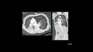 Case of the Week The most likely dx in this pt short of breath is [upl. by Odiug745]