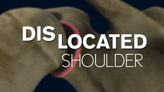 What happens during a shoulder dislocation [upl. by Rad571]