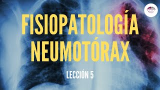 5 FISIOPATOLOGÍA NEUMOTÓRAX FISIOPATOLOGÍA RESPIRATORIA [upl. by Reviere]