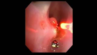 Posterior Glottic Stenosis using UPD with Fiber Dr Fink [upl. by Egon]