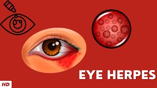 Eye Herpes Causes Signs and Symptoms Diagnosis and Treatment [upl. by Moorefield]