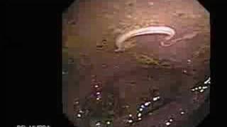 Video Colonoscopy Showing a Parasite in the Cecum [upl. by Maximilianus]