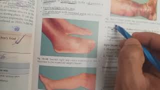 Deep vein thrombosis surgery lecture in hindi [upl. by Subak681]