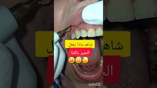 جير الاسنان سبب التهاب لثة شديد dentist stitch اكسبلور stitchfan ترند stitchlover dentistry [upl. by Stochmal]