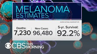 Melanoma Monday Survival rates improving due to treatment advances [upl. by Atnom]