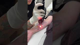 PicoSure Laser treatment at LaserTat [upl. by Margret]