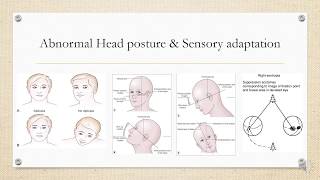 Paralytic squint and its clinical features [upl. by Spalla]