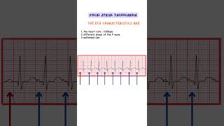 Focal Atrial Tachycardia ecg ecginterpretation medicine doctor nurse [upl. by Darach671]