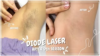 DIODE LASER HAIR REMOVAL  SKINSTATION 10th Session [upl. by Ertnod]