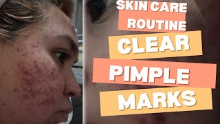 Skin Update Removing Pimple Mark Products How to Clear Pimple Marks YOU Products  ATE Monik [upl. by Sunday]