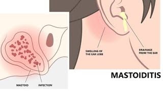 MastoiditisIntroduction of mastoiditis  Definition of mastoiditis Classification of mastoiditis [upl. by Ninette]