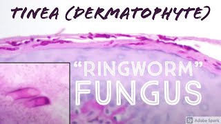 quotRingwormquot under the microscope It’s not a worm  it’s fungus tinea dermatophytosis pathology [upl. by Dilks]