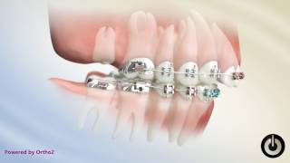 Correcting Overjet by Extracting Upper 2nd Molars [upl. by Hamas]