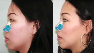 Asian Rhinoplasty Bridge Augmentation Case Study Part 3  Dr Buonassisi 8 West Clinic in BC [upl. by Nira]