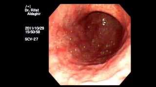 severe H pylori gastritis [upl. by Willman]