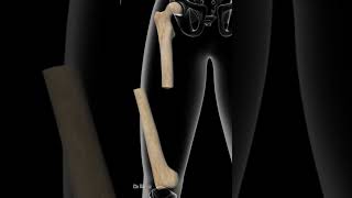 4 Most Painful Femur Shaft Fractures [upl. by Llertnod]