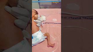 Triplet newborn babies one mother another placenta😱😱newbornbabybabybornnewbornnewborncare [upl. by Ellehcyt602]