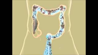 Colon Hydrotherapy in Pune  Constipation Treatment  Piles Treatment  Detox  Colon Cleansing IBS [upl. by Iliram]