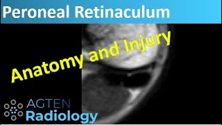 Superior Peroneal Retinaculum  MRI Anatomy and Injuries [upl. by Annaili]