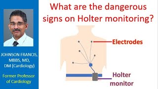 What are the dangerous signs on Holter monitoring [upl. by Atikin467]