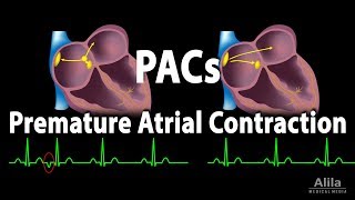 Premature Atrial Contractions PACs Animation [upl. by Ellette683]