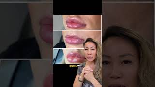 Got lip filler migration Heres what to do medspa beyoutymedspa skincare kyliejennerchallenge [upl. by Ahsac]