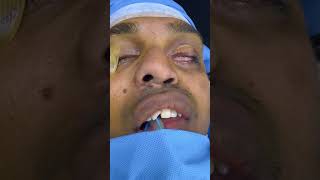 Asymmetrical Bent Blocked Nose corrected by rhinoplasty esthetic plastic surgery at Bangalore [upl. by Silsby]