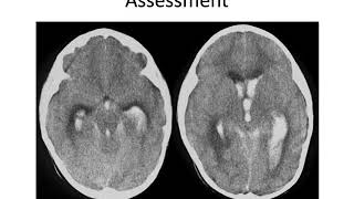 Increased Intracranial Pressure IICP [upl. by Lerat758]