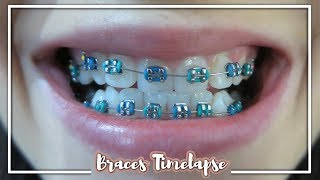 Full Braces TimeLapse With Timestamps [upl. by Nnyletak906]