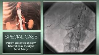 Thoracoabdominal aortic aneurysm a totally endovascular approach with a branched stentgraft [upl. by Lesser]