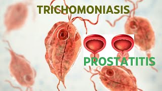 TRICHOMONIASIS ROLE IN PROSTATITIS [upl. by Eecyal]