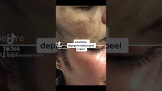 cosmelan Depigmenration Peel shorts pigmentation pigmentationsolution [upl. by Naaitsirhc170]