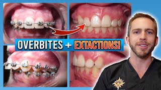 Braces Overbite Treatment BEFORE amp AFTER [upl. by Eustazio]