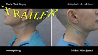 36 Lifting elastico del collo basso TRAILER [upl. by Grey595]