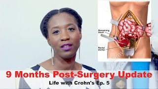 9 Months PostSurgery Update I Life with Crohns Ep 5 [upl. by Aliuqehs]