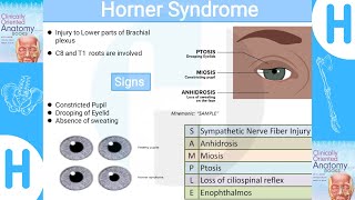 Horner SyndromeClinical manifestations diagnosis and management [upl. by Naihtniroc]