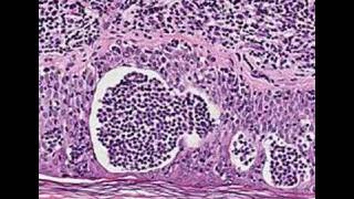 Histopathology SkinMycosis fungoides [upl. by Nahtnoj]