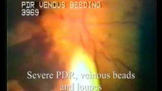 VideoDocumentation of Retinal Diseases [upl. by Eilarol]