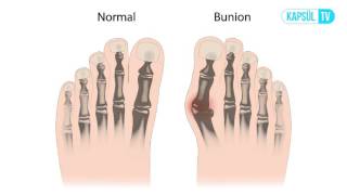 Ayak Baş Parmağı Çıkıntısı Nedir Neden Olur [upl. by Ecnaralc]