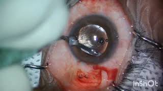 Intraocular Lens exchange SurgeryAlcon Vivitysurgeonlife ophthalmologist youtubeshorts vision [upl. by Beaufert]