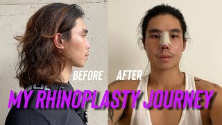 I HAD A NOSE JOB Rhinoplasty at The Icon Clinic Part 1  Jeff Ong [upl. by Arek966]