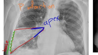 Focal lung lesion chest Xray in Kurdish [upl. by Rollecnahc899]