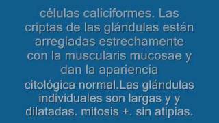 polipos intestinales1wmv [upl. by Alicirp438]