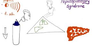 Hepatopulmonary syndrome the clinical triad [upl. by Morna946]