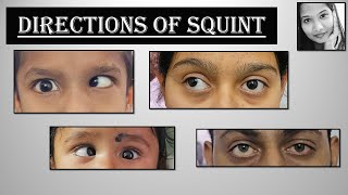 Different Directions of Ocular Deviation  Esotropia Exotropia Hypertropia Hypotropia  Squint [upl. by Rutger]